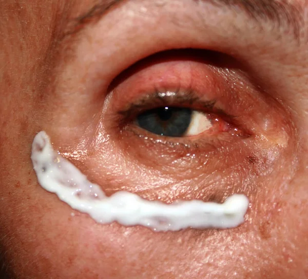 Wrinkle cream application under the eyes. Wrinkles on the eyelid. — Stock Photo, Image