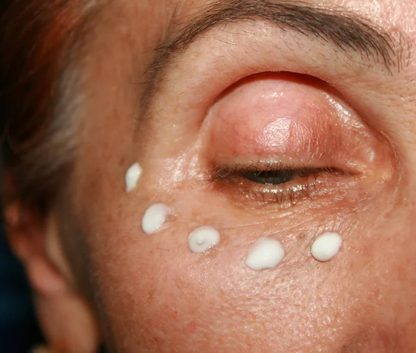 Gözlerinin altında Kırışıklık krem uygulama. Göz kapağı kırışıklıkları.