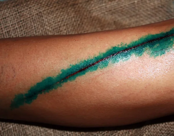 Длинный порез на теле, обработанном зеленью. Рана на коже — стоковое фото