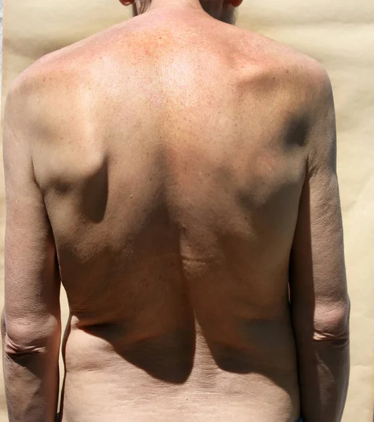 Scoliosis. Rachiocampsis. Kyphosis. Curvature of the spine — Stock Photo, Image