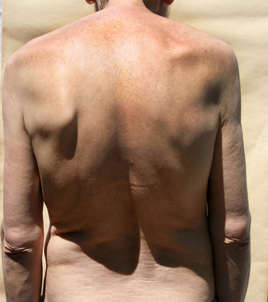 Scoliosis. Rachiocampsis. Kyphosis. Curvature of the spine