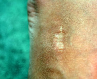 Deride bir yara izi. Cicatrice vücut üzerinde