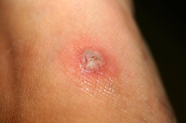 Mısır cilt üzerinde. Mısır attı. Hidrojen peroksit ile yara tedavisi