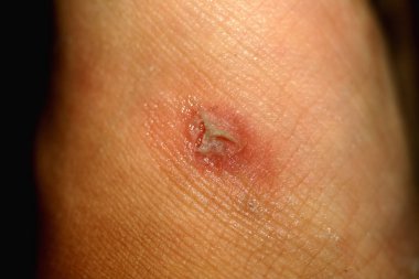 Mısır cilt üzerinde. Mısır haşhaş.