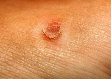 Mısır cilt üzerinde. Mısır haşhaş.