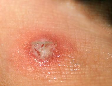 Mısır cilt üzerinde. Mısır attı. Hidrojen peroksit ile yara tedavisi