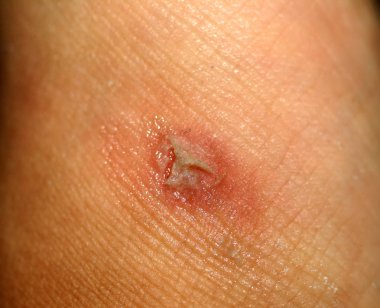 Mısır cilt üzerinde. Mısır attı. Hidrojen peroksit ile yara tedavisi