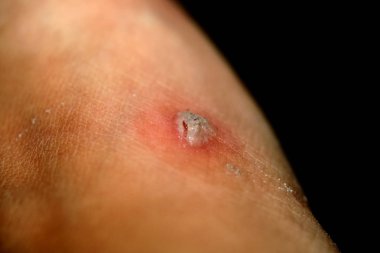 Mısır cilt üzerinde. Mısır attı. Hidrojen peroksit ile yara tedavisi