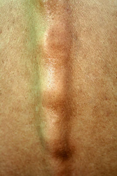 Dışbükey omurga arkasında. Spondiloz omurga.