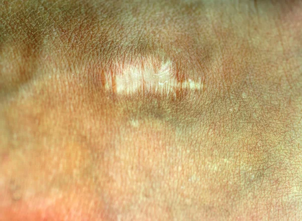 Uma cicatriz na pele. Cicatrice no corpo — Fotografia de Stock