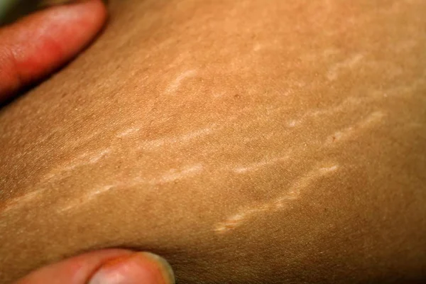 Stretch marks on the skin. Scars on the body. Stretch marks on legs. Cellulite. — Stock Photo, Image