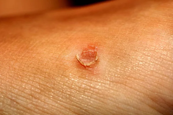 Mısır cilt üzerinde. Mısır haşhaş.