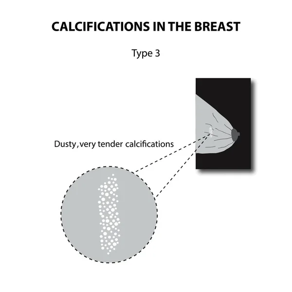 Kalkafzettingen in de borst. Mammografie. De melkklier. Infographics. Vectorillustratie op geïsoleerde achtergrond — Stockvector