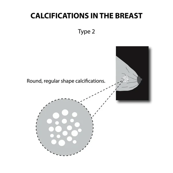 Kalkafzettingen in de borst. Mammografie. De melkklier. Infographics. Vectorillustratie op geïsoleerde achtergrond — Stockvector