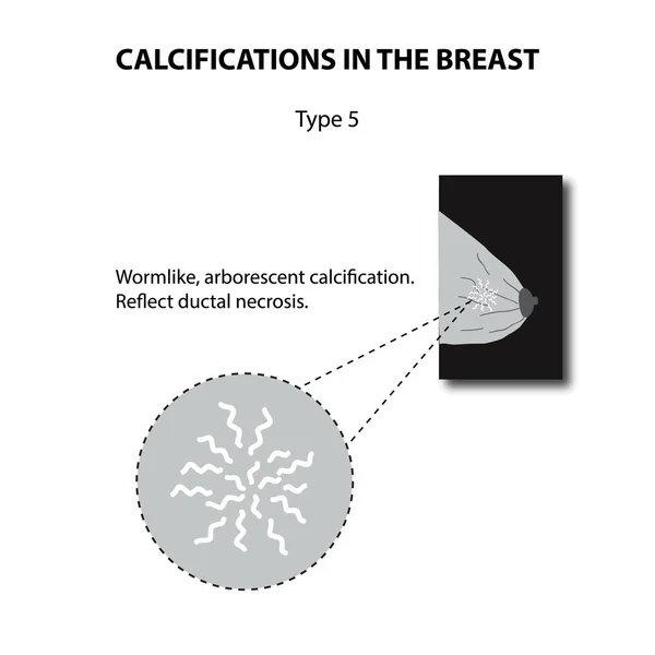 Calcificaciones en el pecho. Mamografía. La glándula mamaria. Infografías. Ilustración vectorial sobre fondo aislado — Archivo Imágenes Vectoriales