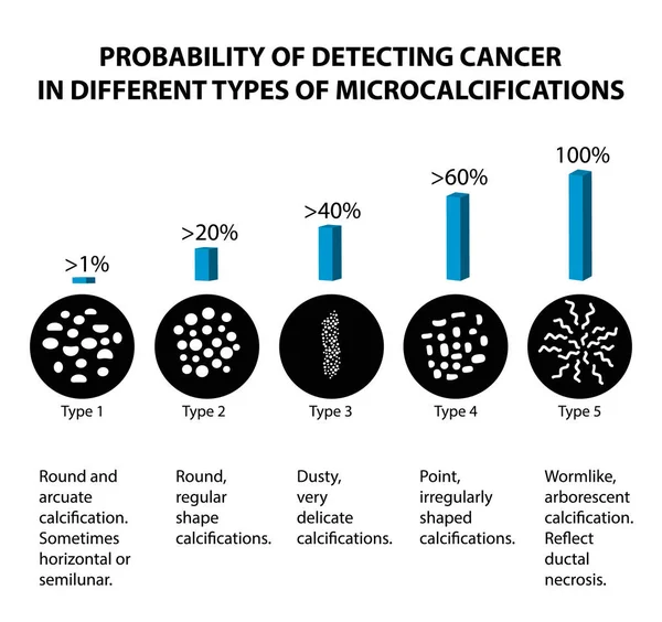 A probabilidade de detectar câncer de mama com diferentes tipos de microcalcinados. Mamografia. Infográficos. Ilustração vetorial sobre fundo isolado — Vetor de Stock