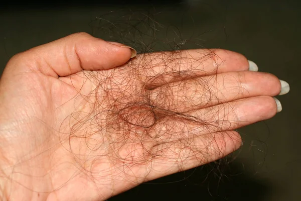 A dropped stick of hair in his hand. Hair loss. — Stock Photo, Image