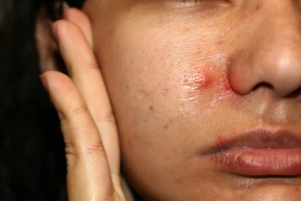 Inflamação na pele do rosto. Espinhas vermelhas purulentas. Acne. Cicatrizes queloides. Poros expandidos — Fotografia de Stock