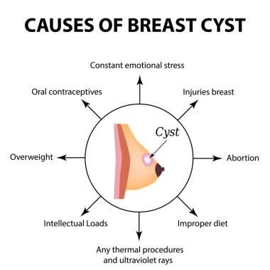 Meme bezi kisti nedenleri. Dünya meme kanser günü. Tümör. Vektör illüstrasyon izole arka plan üzerinde