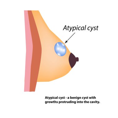 Tipik bir göğüs kisti. Meme bezi. Dünya Göğüs Kanseri Günü. İzole edilmiş arkaplanda vektör illüstrasyonu