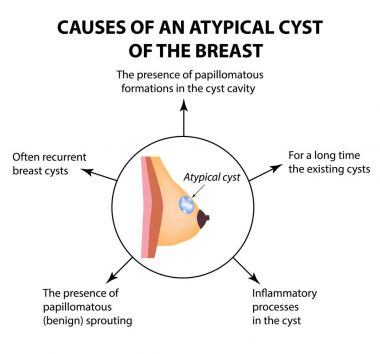 Meme bezi atipik bir kist nedenleri. Dünya meme kanser günü. Tümör. Vektör illüstrasyon izole arka plan üzerinde