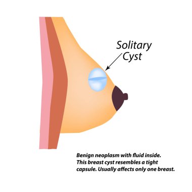 Meme bezi içinde katı bir kist. Dünya meme kanser günü. Soliter kisti. Vektör illüstrasyon izole arka plan üzerinde