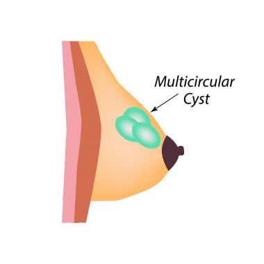 Multicameral kist. Dünya meme kanser günü. Tümör. Vektör illüstrasyon izole arka plan üzerinde