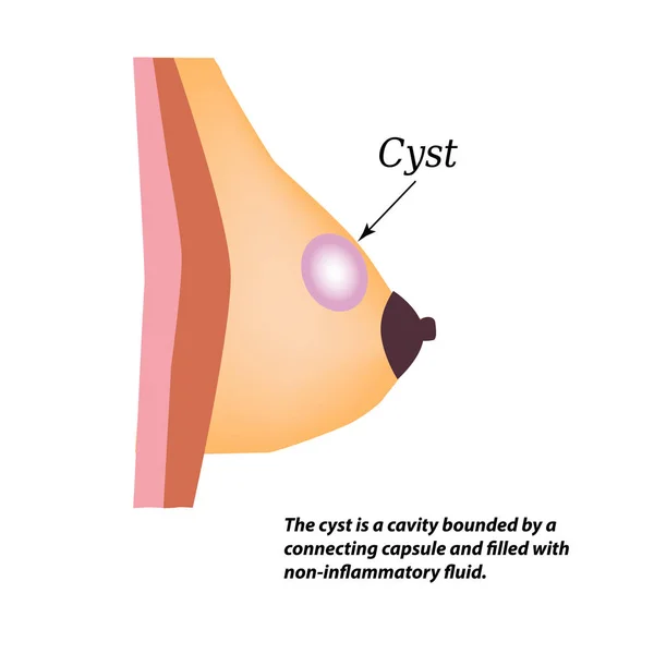 Cisto na glândula mamária. Dia Mundial do Câncer de Mama. Ilustração vetorial sobre fundo isolado — Vetor de Stock