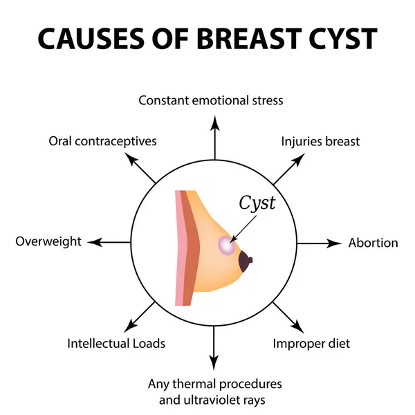 Orsaker av cysta i bröstkörteln. Världscancerdagen för bröstcancer. Tumör. Vektorillustration på isolerade bakgrund — Stock vektor