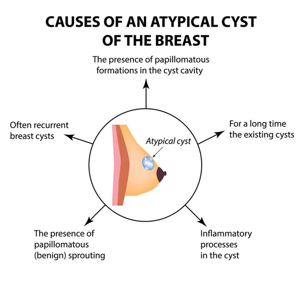 Causas de un quiste atípico en la glándula mamaria. Día Mundial del Cáncer de Mama. Tumor. Ilustración vectorial sobre fondo aislado — Vector de stock