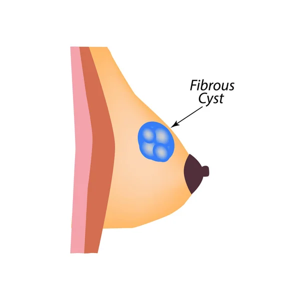 Seno a cisti fibrosa. Giornata mondiale del cancro al seno. Tumore della ghiandola mammaria. Illustrazione vettoriale su sfondo isolato — Vettoriale Stock