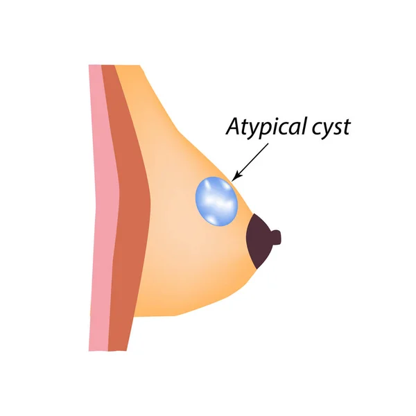 Atypiska cysta i bröstet. Mjölkkörtel. Världsbröstcancerdagen. Vektor illustration på isolerad bakgrund — Stock vektor