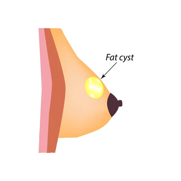 Seios de cisto gordos. Cisto gordo. Dia Mundial do Câncer de Mama. Tumor da glândula mamária. Ilustração vetorial sobre fundo isolado — Vetor de Stock