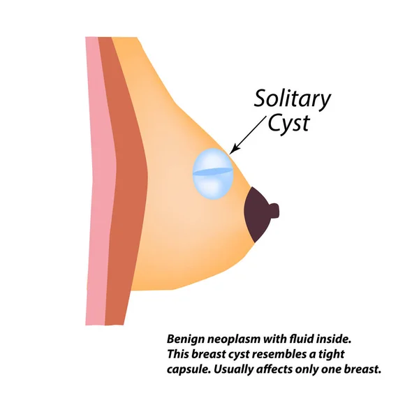 Un quiste sólido en la glándula mamaria. Día Mundial del Cáncer de Mama. Quiste solitario. Ilustración vectorial sobre fondo aislado — Vector de stock