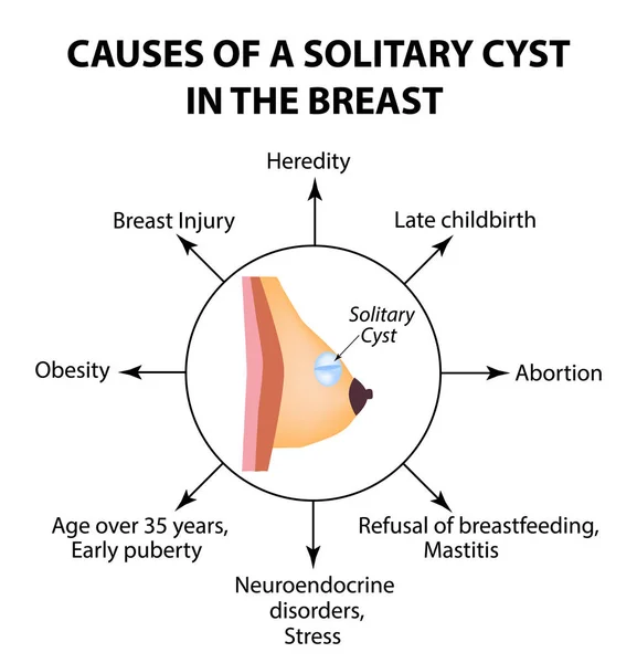 Orsakerna till en solitär cysta i bröstet. Världscancerdagen för bröstcancer. En solid cysta. Vektorillustration på isolerade bakgrund — Stock vektor