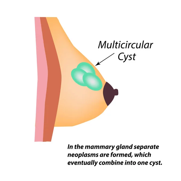 Cisto multicameral. Dia Mundial do Câncer de Mama. Tumor. Ilustração vetorial sobre fundo isolado — Vetor de Stock