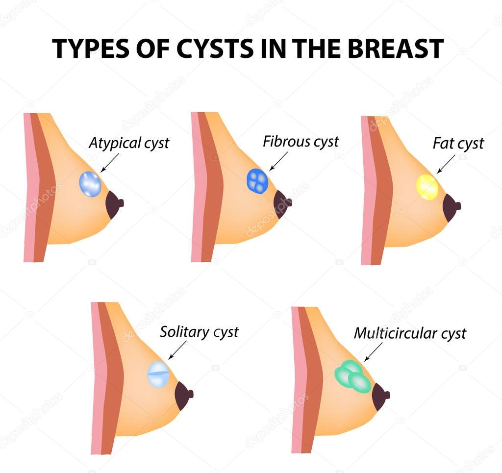 Types of cysts in the breast. Atypical, Fibrous, Fatty cyst, Solid cyst, Multicameral. World Breast Cancer Day. Tumor. Set. Vector illustration on isolated background