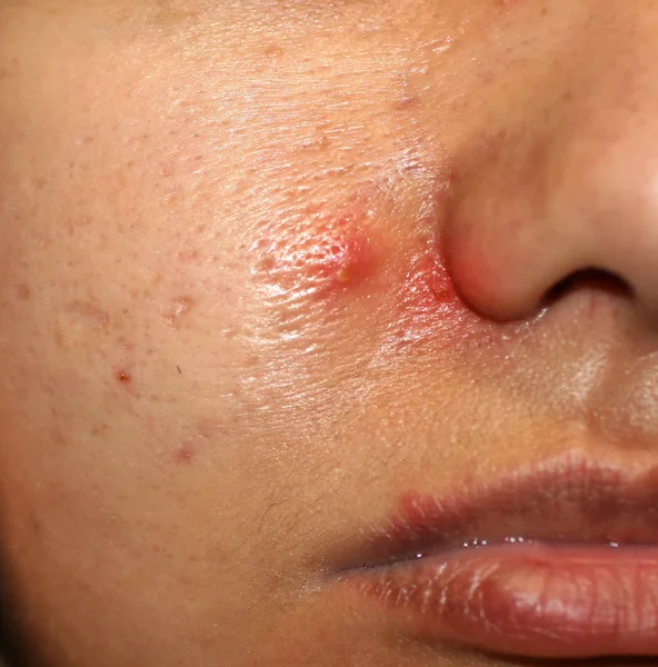 Inflamação na pele do rosto. Espinhas vermelhas purulentas. Acne. Cicatrizes queloides. Poros expandidos — Fotografia de Stock