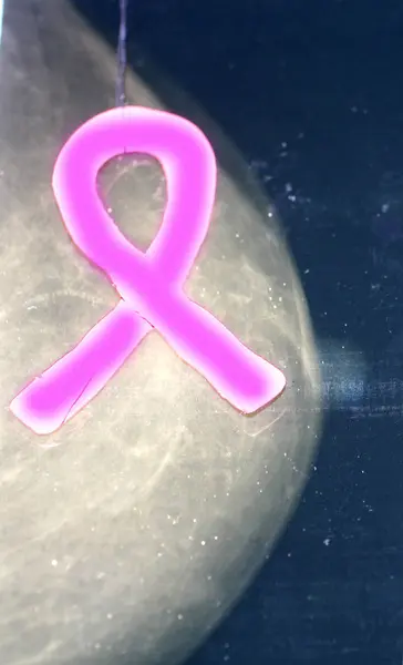 Розовая лента на фоне маммографического изображения. Рентген. Всемирный день борьбы с раком груди — стоковое фото