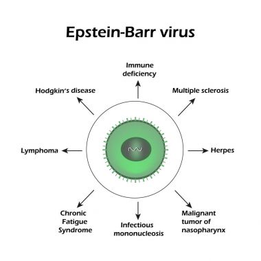 Epstein - Barr virüsü. Bir virüsünün yol açtığı hastalıklar. Infographics. Vektör çizim