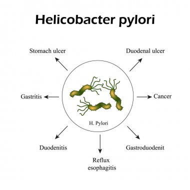 Helicobacter pylori. Helicobacter pylori tarafından neden olduğu hastalıklar. Helicobacter enfeksiyonu. Infographics. Vektör çizim