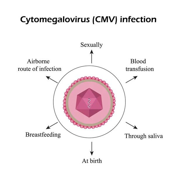 Cytomegalovirus. Penyakit yang disebabkan oleh sitomegalovirus. Infografis. Ilustrasi vektor - Stok Vektor