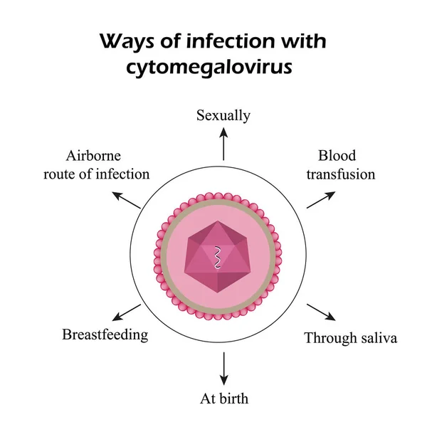 Citomegalovirus. Enfermedades causadas por citomegalovirus. Infografías. Ilustración vectorial — Vector de stock