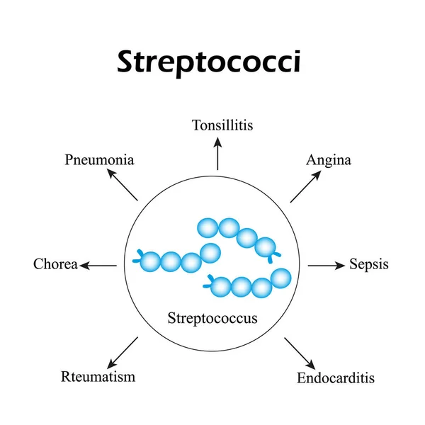 Estreptococos. Enfermedades estreptocócicas. Infografías. Ilustración vectorial — Archivo Imágenes Vectoriales