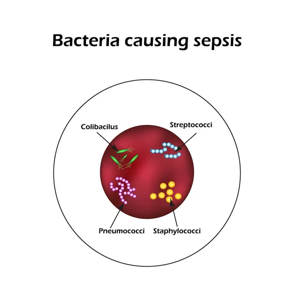 Sepsis. Bloed vergiftiging. E. coli. Streptokokken. Pneumokokken. Stafylokokken. Infographics. Vectorillustratie — Stockvector