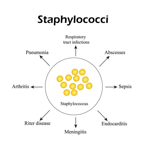 Estafilococos. Staphylococcus aureus causa enfermedades. Infografías. Ilustración vectorial — Vector de stock