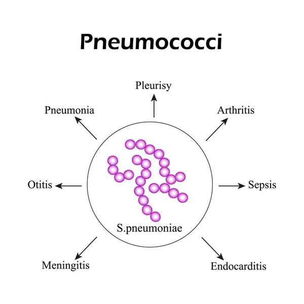 Pneumokoky. Pneumokokové nemoci. Infografika. Vektorové ilustrace — Stockový vektor