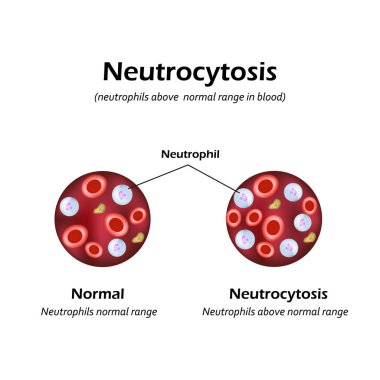 Neutrophils were above the normal range in the blood. Neutrocytosis. Vector illustration clipart