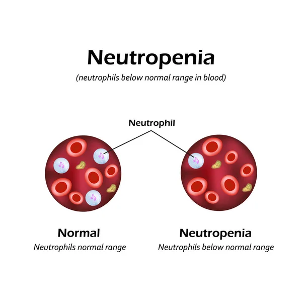 Neutrofiler under det normala intervallet i blodet. Neutropeni. Vektorillustration — Stock vektor
