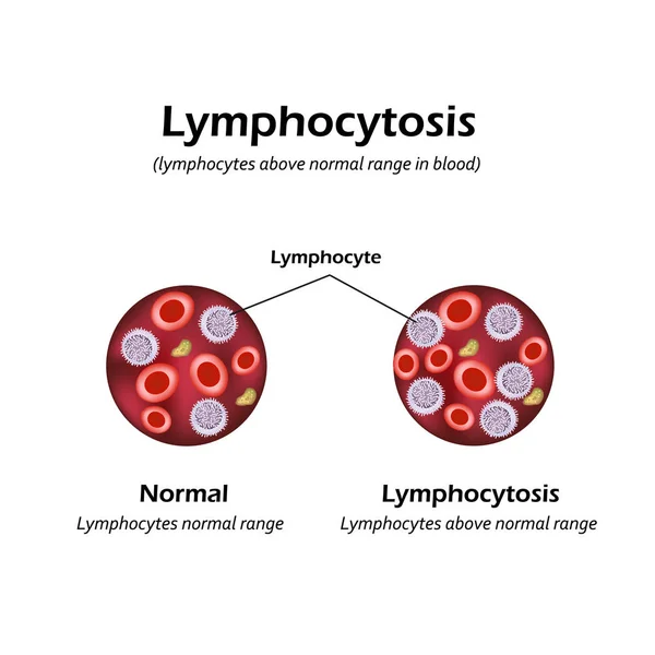 Лимфоциты выше нормального диапазона в крови. Лимфоцитоз. Векторная иллюстрация — стоковый вектор
